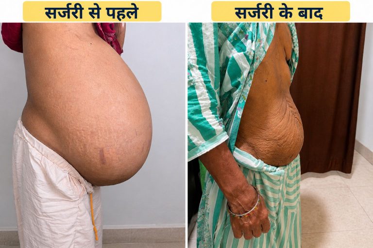 पेट में 15 किलो की गाँठ लेकर पहुँची महिला, सफल कैंसर सर्जरी से मिली नई जिंदगी